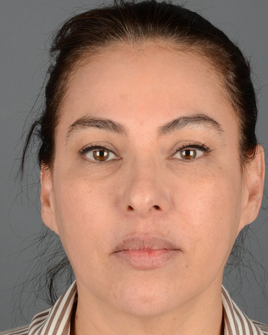 Rostro antes del rejuvenecimiento facial, caso 1
