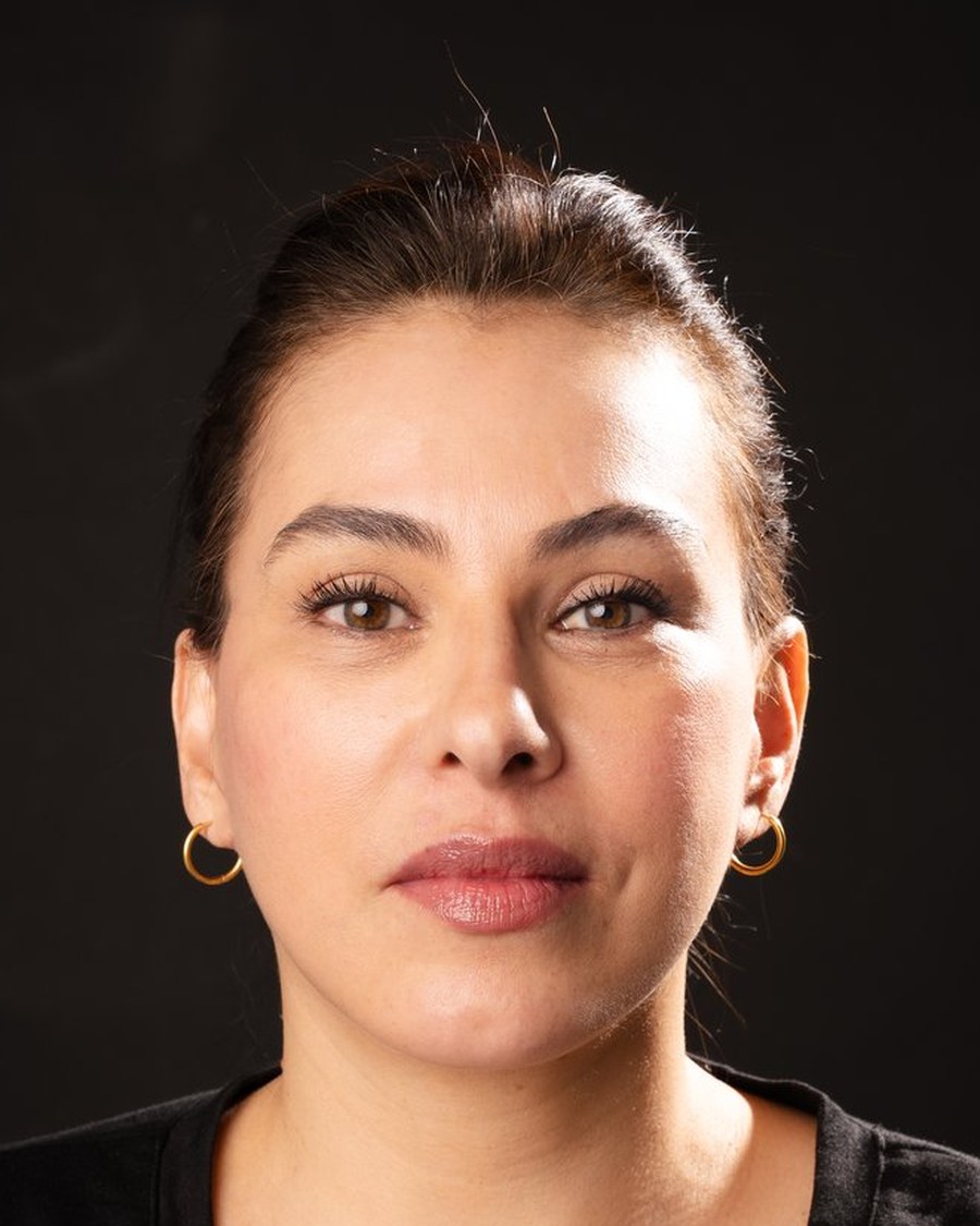 Resultado del rejuvenecimiento facial, caso 1, después