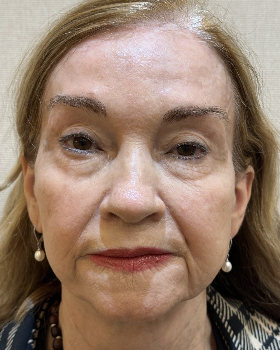 Rostro antes del rejuvenecimiento facial, caso 2
