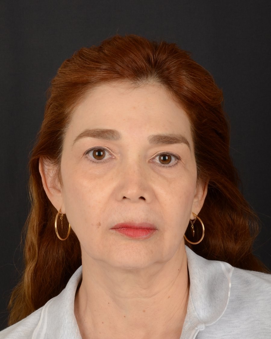 Rostro antes del rejuvenecimiento facial, caso 3