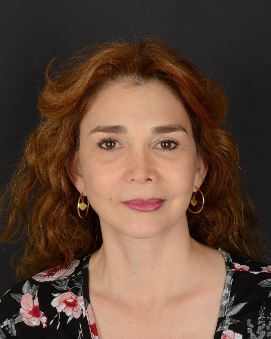 Resultado del rejuvenecimiento facial, caso 3, después