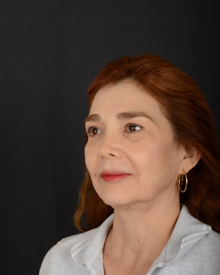 Caso 3, ángulo de lado, antes