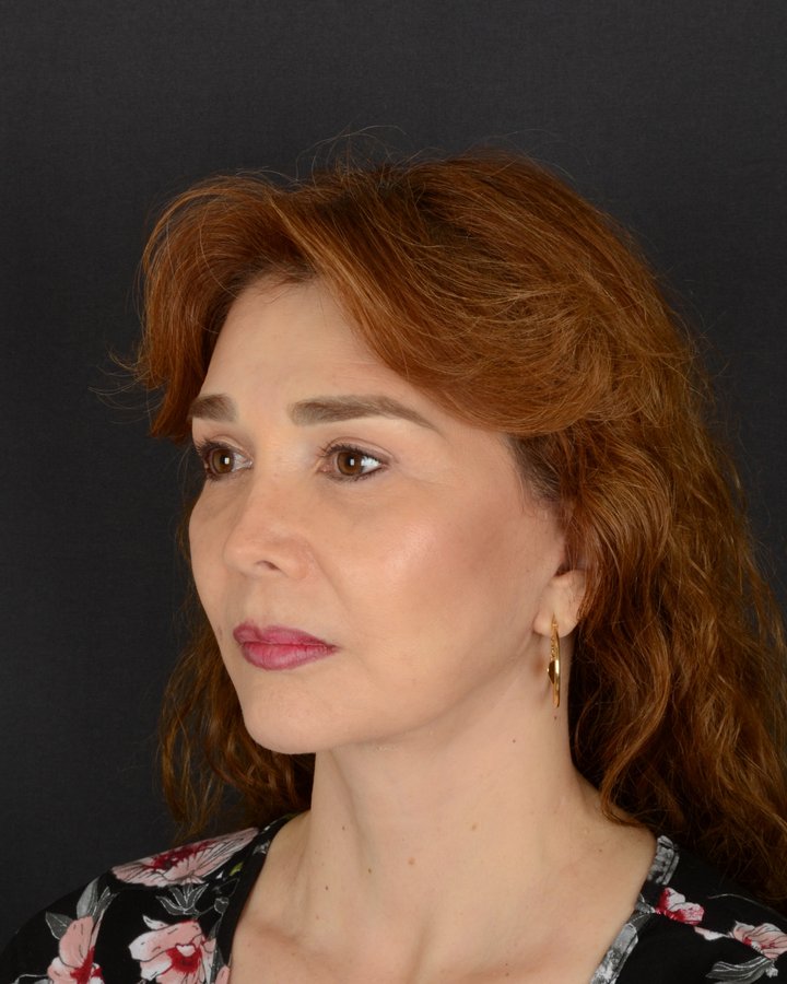 Caso 3, ángulo de lado, después