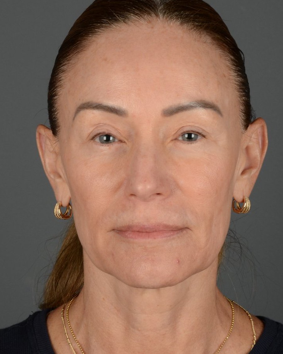 Rostro antes del rejuvenecimiento facial, caso 4